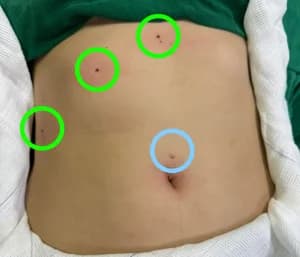 Colecistectomia por Mini Laparoscopia e Videolaparoscopia